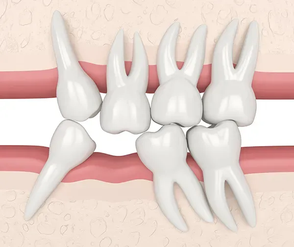 IMG effects of tooth loss AdobeStock 340935886