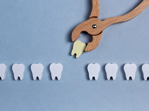 IMG tooth extraction AdobeStock 500315607