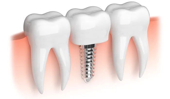 Why You Should Consider Dental Implants in 2021