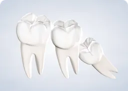 Home Wisdom Teeth Removal