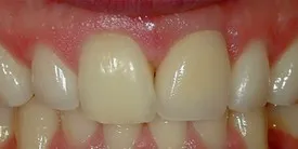 Implant surgery case 0 after