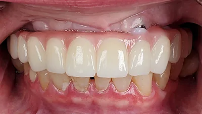 Implant surgery case 2 after 2
