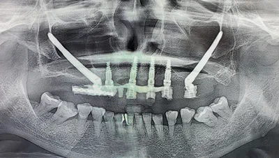 Implant surgery case 2 after 3