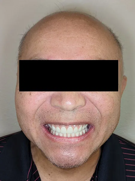 Implant surgery case 4 after 1