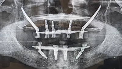 Implant surgery case 4 after 3