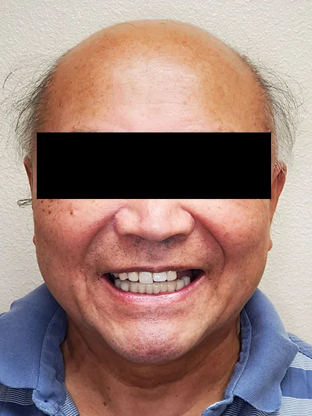 Implant surgery case 4 before 1