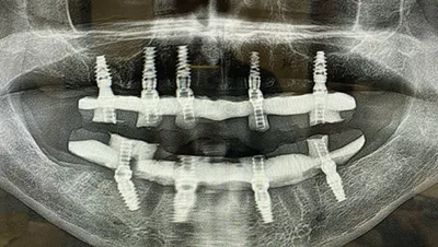 Implant surgery case 5 after 3