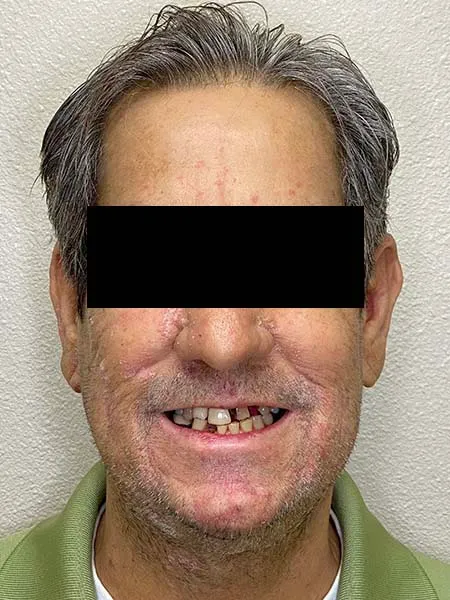 Implant surgery case 5 before 1