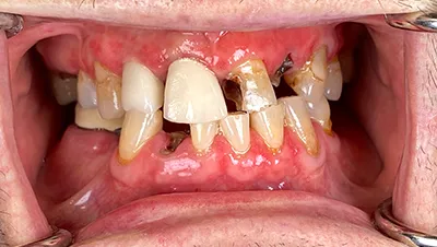 Implant surgery case 5 before 2
