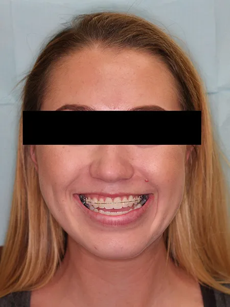 Jaw surgery case 1 before