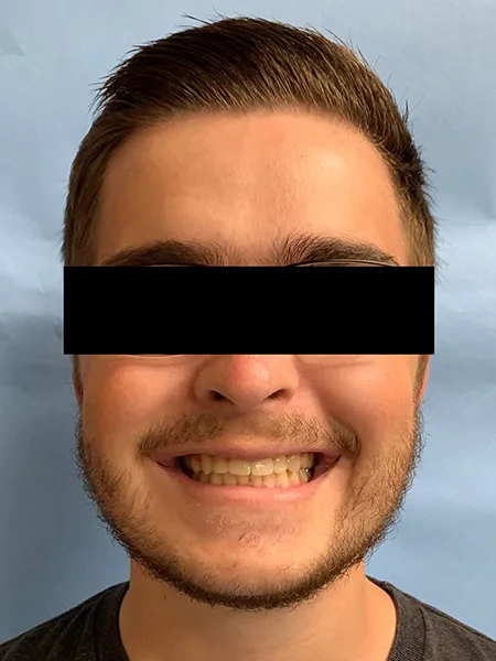 Jaw surgery case 2 after