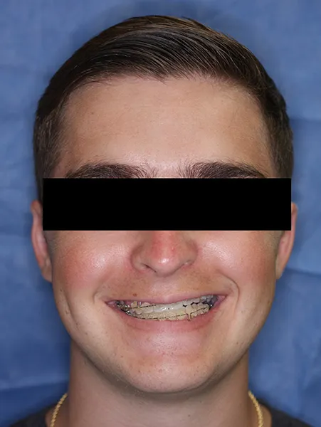 Jaw surgery case 2 before