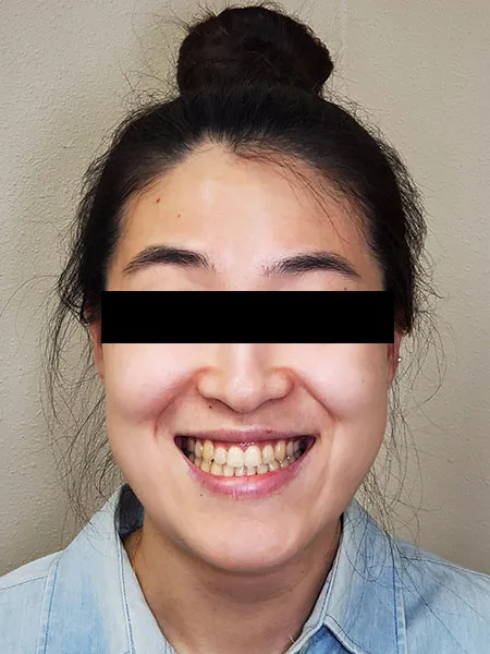 Jaw surgery case 3 after