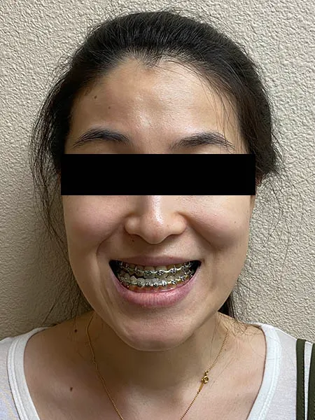 Jaw surgery case 3 before
