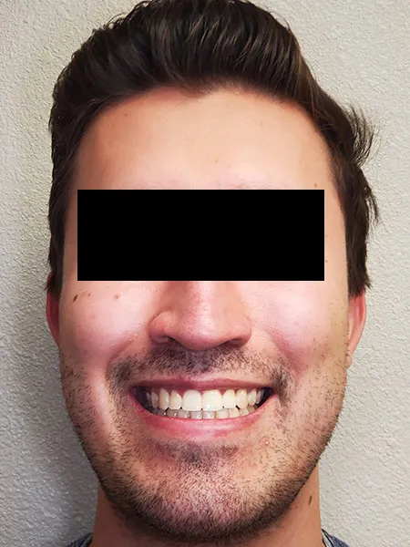 Jaw surgery case 4 after