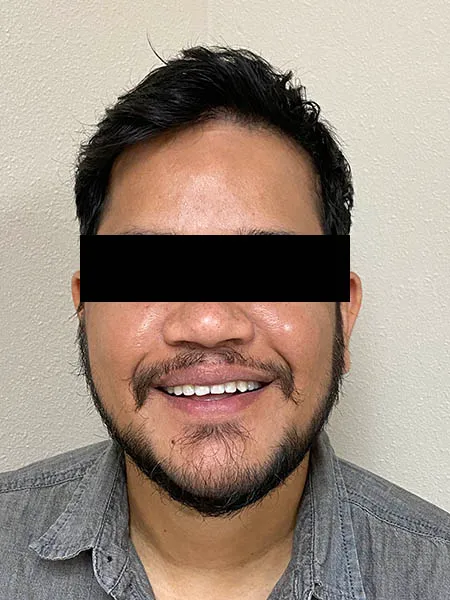 Jaw surgery case 5 after