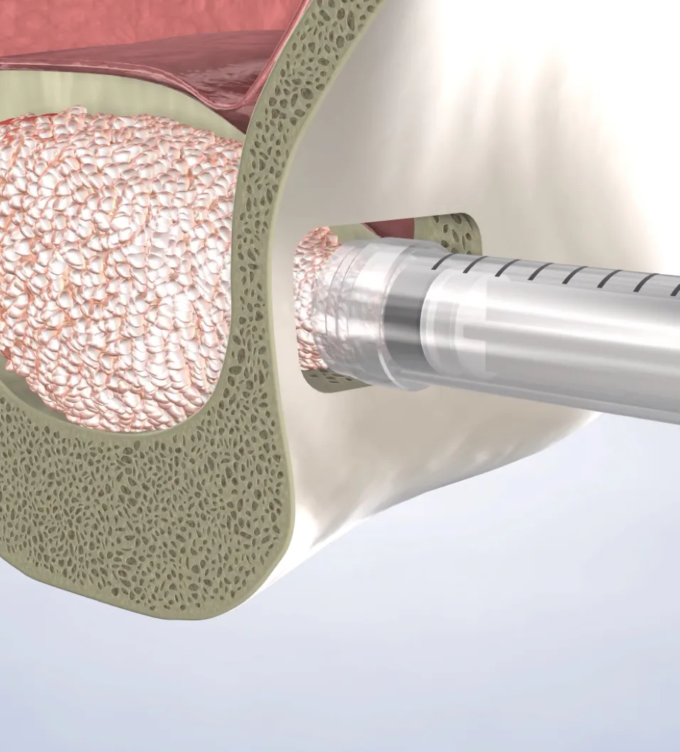 query  sinus lift